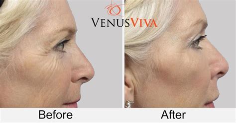 Venus Viva Skin Resurfacing .